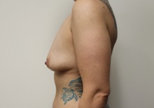 Breast Lift Before Photo by Kyle Shaddix, MD; Pensacola, FL - Case 37436