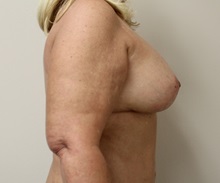 Breast Lift After Photo by Kyle Shaddix, MD; Pensacola, FL - Case 37437