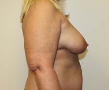 Breast Lift Before Photo by Kyle Shaddix, MD; Pensacola, FL - Case 37437