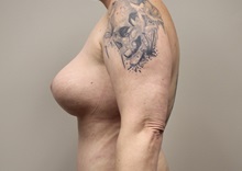 Breast Lift After Photo by Kyle Shaddix, MD; Pensacola, FL - Case 37438