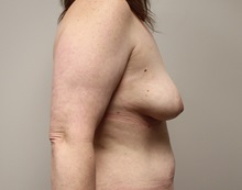 Breast Lift Before Photo by Kyle Shaddix, MD; Pensacola, FL - Case 37438