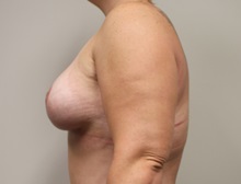 Breast Lift After Photo by Kyle Shaddix, MD; Pensacola, FL - Case 37456