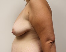 Breast Lift Before Photo by Kyle Shaddix, MD; Pensacola, FL - Case 37460
