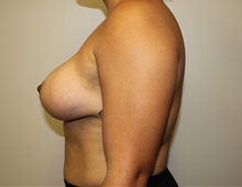 Breast Lift After Photo by Kyle Shaddix, MD; Pensacola, FL - Case 37464