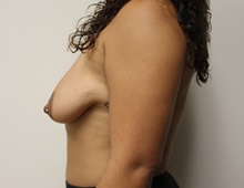 Breast Lift Before Photo by Kyle Shaddix, MD; Pensacola, FL - Case 37464