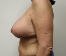 Breast Lift After Photo by Kyle Shaddix, MD; Pensacola, FL - Case 37477