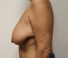 Breast Lift Before Photo by Kyle Shaddix, MD; Pensacola, FL - Case 37477