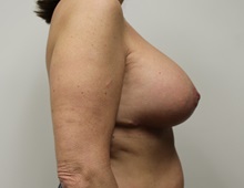 Breast Lift After Photo by Kyle Shaddix, MD; Pensacola, FL - Case 37477
