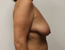 Breast Lift Before Photo by Kyle Shaddix, MD; Pensacola, FL - Case 37477
