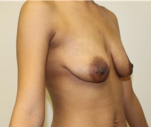 Breast Lift Before Photo by Kyle Shaddix, MD; Pensacola, FL - Case 37479