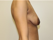 Breast Lift Before Photo by Kyle Shaddix, MD; Pensacola, FL - Case 37479