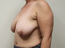 Breast Lift Before Photo by Kyle Shaddix, MD; Pensacola, FL - Case 37484