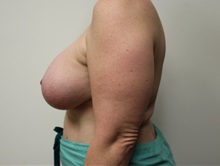 Breast Lift After Photo by Kyle Shaddix, MD; Pensacola, FL - Case 37484