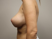 Breast Lift After Photo by Kyle Shaddix, MD; Pensacola, FL - Case 37488