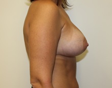 Breast Augmentation After Photo by Kyle Shaddix, MD; Pensacola, FL - Case 37564
