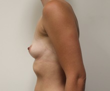 Breast Augmentation Before Photo by Kyle Shaddix, MD; Pensacola, FL - Case 37570