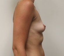 Breast Augmentation Before Photo by Kyle Shaddix, MD; Pensacola, FL - Case 37570