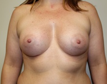 Breast Augmentation After Photo by Kyle Shaddix, MD; Pensacola, FL - Case 37571