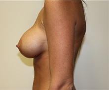 Breast Augmentation After Photo by Kyle Shaddix, MD; Pensacola, FL - Case 37580