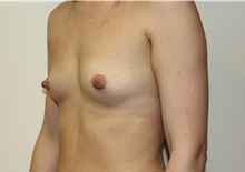 Breast Augmentation Before Photo by Kyle Shaddix, MD; Pensacola, FL - Case 37583