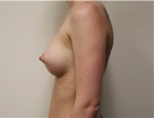 Breast Augmentation After Photo by Kyle Shaddix, MD; Pensacola, FL - Case 37583