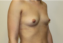 Breast Augmentation Before Photo by Kyle Shaddix, MD; Pensacola, FL - Case 37583