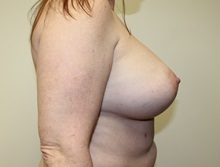 Breast Augmentation After Photo by Kyle Shaddix, MD; Pensacola, FL - Case 37622