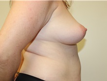 Breast Augmentation Before Photo by Kyle Shaddix, MD; Pensacola, FL - Case 37622