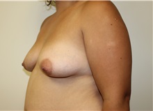 Breast Augmentation Before Photo by Kyle Shaddix, MD; Pensacola, FL - Case 37624