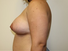 Breast Augmentation After Photo by Kyle Shaddix, MD; Pensacola, FL - Case 37624
