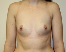 Breast Augmentation Before Photo by Kyle Shaddix, MD; Pensacola, FL - Case 37626