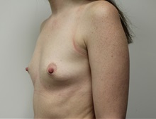 Breast Augmentation Before Photo by Kyle Shaddix, MD; Pensacola, FL - Case 37626