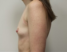 Breast Augmentation Before Photo by Kyle Shaddix, MD; Pensacola, FL - Case 37626
