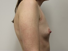 Breast Augmentation Before Photo by Kyle Shaddix, MD; Pensacola, FL - Case 37626