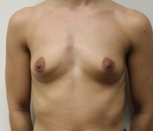 Breast Augmentation Before Photo by Kyle Shaddix, MD; Pensacola, FL - Case 37634