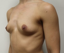 Breast Augmentation Before Photo by Kyle Shaddix, MD; Pensacola, FL - Case 37634