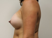 Breast Augmentation After Photo by Kyle Shaddix, MD; Pensacola, FL - Case 37645