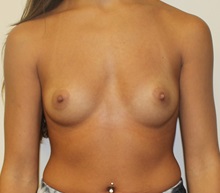 Breast Augmentation Before Photo by Kyle Shaddix, MD; Pensacola, FL - Case 37668