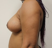Breast Augmentation After Photo by Kyle Shaddix, MD; Pensacola, FL - Case 37670