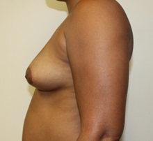 Breast Augmentation Before Photo by Kyle Shaddix, MD; Pensacola, FL - Case 37670