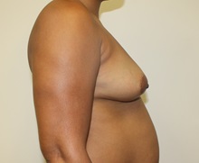 Breast Augmentation Before Photo by Kyle Shaddix, MD; Pensacola, FL - Case 37670
