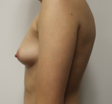 Breast Augmentation Before Photo by Kyle Shaddix, MD; Pensacola, FL - Case 37676