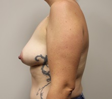 Breast Lift Before Photo by Kyle Shaddix, MD; Pensacola, FL - Case 37977