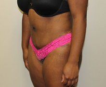 Tummy Tuck After Photo by Kyle Shaddix, MD; Pensacola, FL - Case 38021