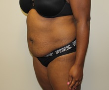 Tummy Tuck Before Photo by Kyle Shaddix, MD; Pensacola, FL - Case 38021