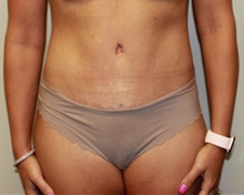 Tummy Tuck After Photo by Kyle Shaddix, MD; Pensacola, FL - Case 38173