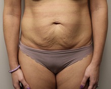 Tummy Tuck Before Photo by Kyle Shaddix, MD; Pensacola, FL - Case 38173