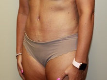 Tummy Tuck After Photo by Kyle Shaddix, MD; Pensacola, FL - Case 38173