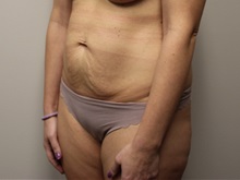 Tummy Tuck Before Photo by Kyle Shaddix, MD; Pensacola, FL - Case 38173