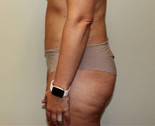 Tummy Tuck After Photo by Kyle Shaddix, MD; Pensacola, FL - Case 38173